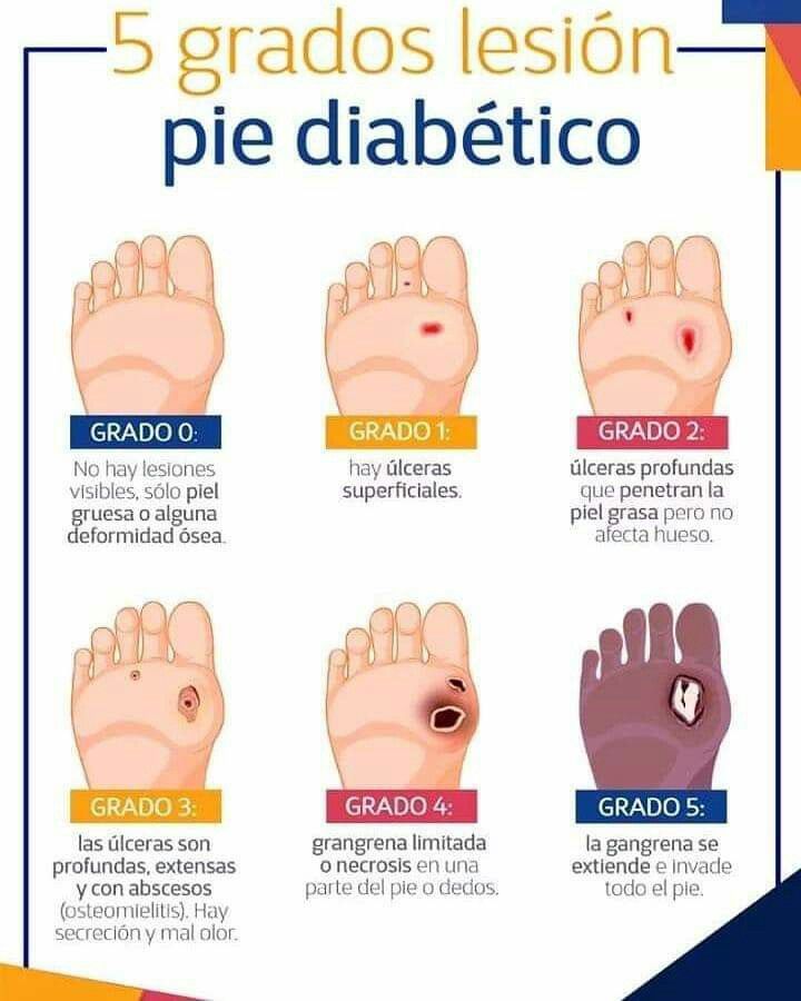 pie diabetico riobamba