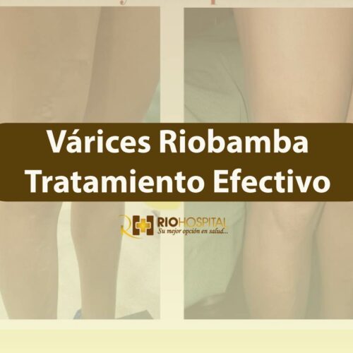varices riobamba