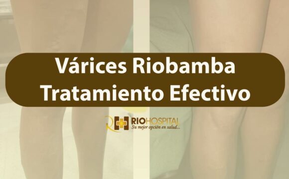 varices riobamba