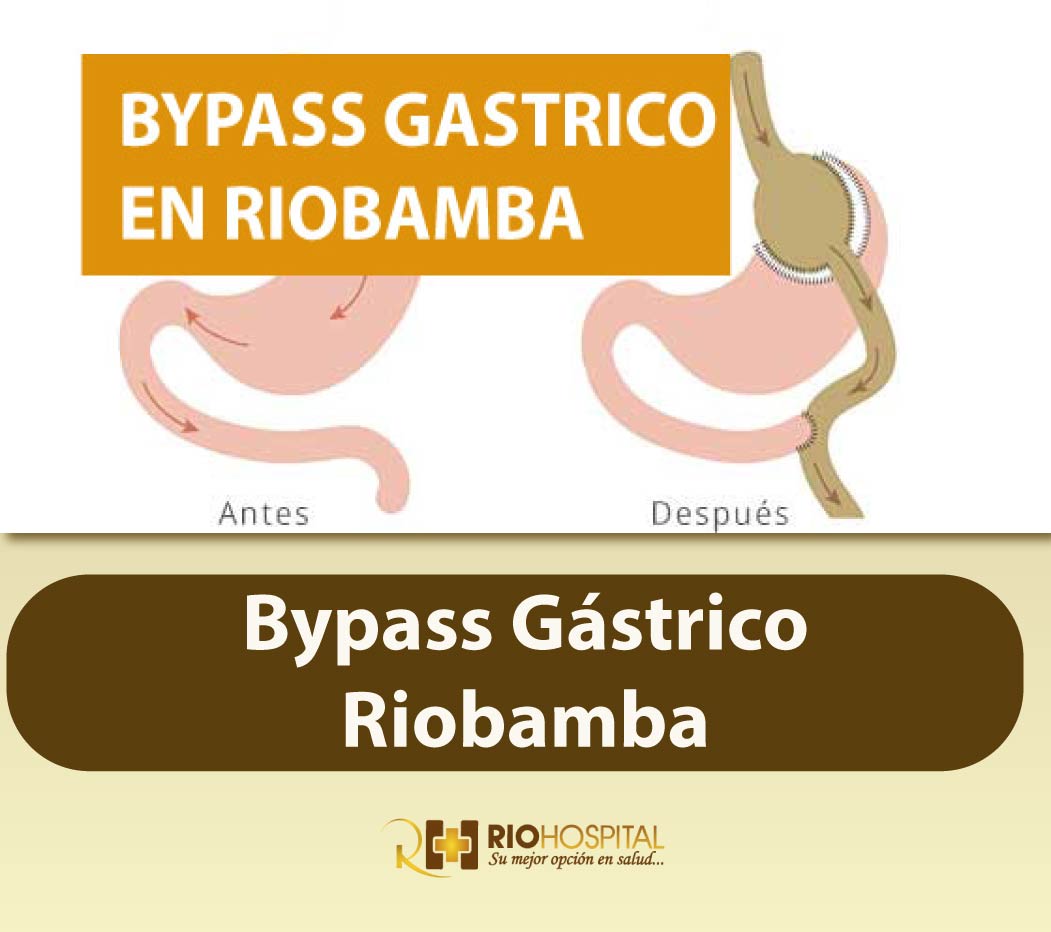BYPASS GASTRICO RIOBAMBA