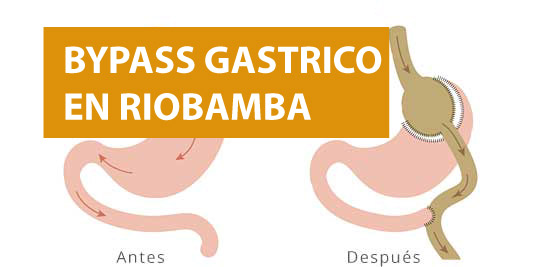 BYPASS GASTRICO RIOBAMBA